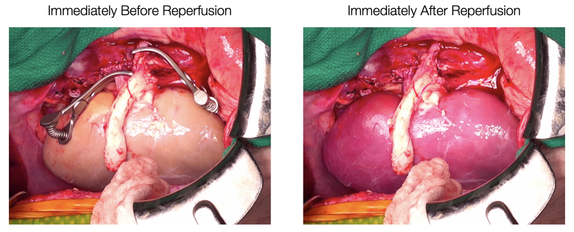 Supercooled kidneys have been transplanted into pigs in a “landmark achievement”